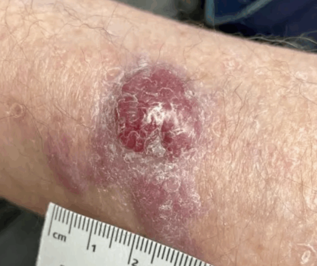 a close up photo of a merkel cell carcinoma lesion on a patient's arm, with a ruler beside to measure size