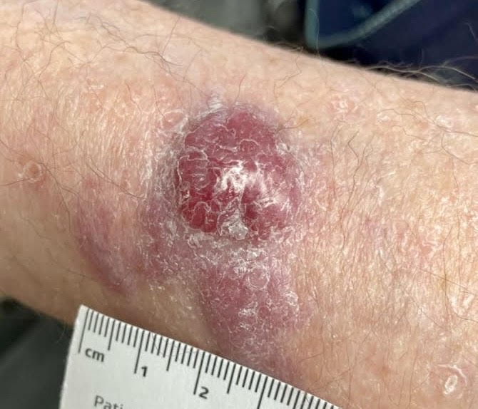 Merkel cell carcinoma
