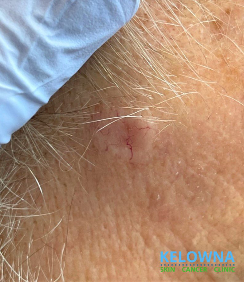 Invasive micronodular basal cell carcinoma, clinical view