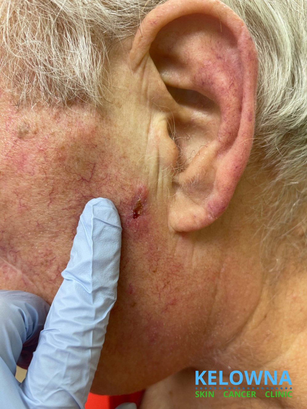 Deeply invasive squamous cell carcinoma with perineural invasion.