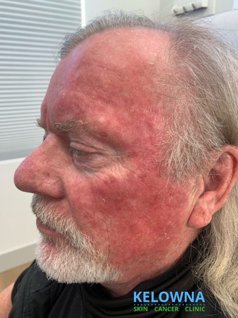 Right side of face of an elderly male after Efudex Treatment.