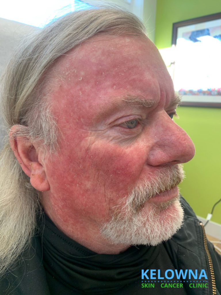 Left side of face on an elderly male after Efudex Treatment.