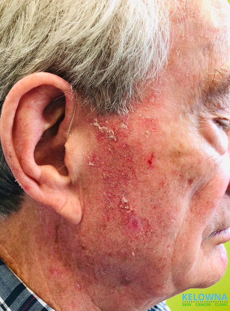 Side of face of a 65 year old male with advanced actinic keratosis on his face ad scalp.