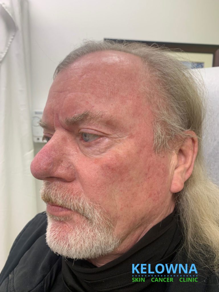 Right side of face on an elderly male 6 weeks after one cycle of Efudex Treatment.