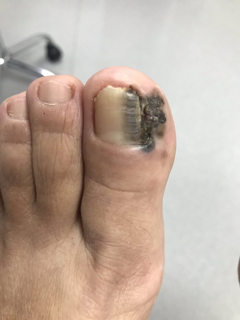 Melanoma skin cancer that has developed under the corner of a person's toenail and on the side of their big toe.