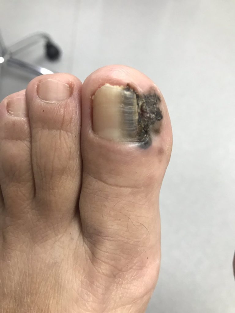 melanoma on big toe