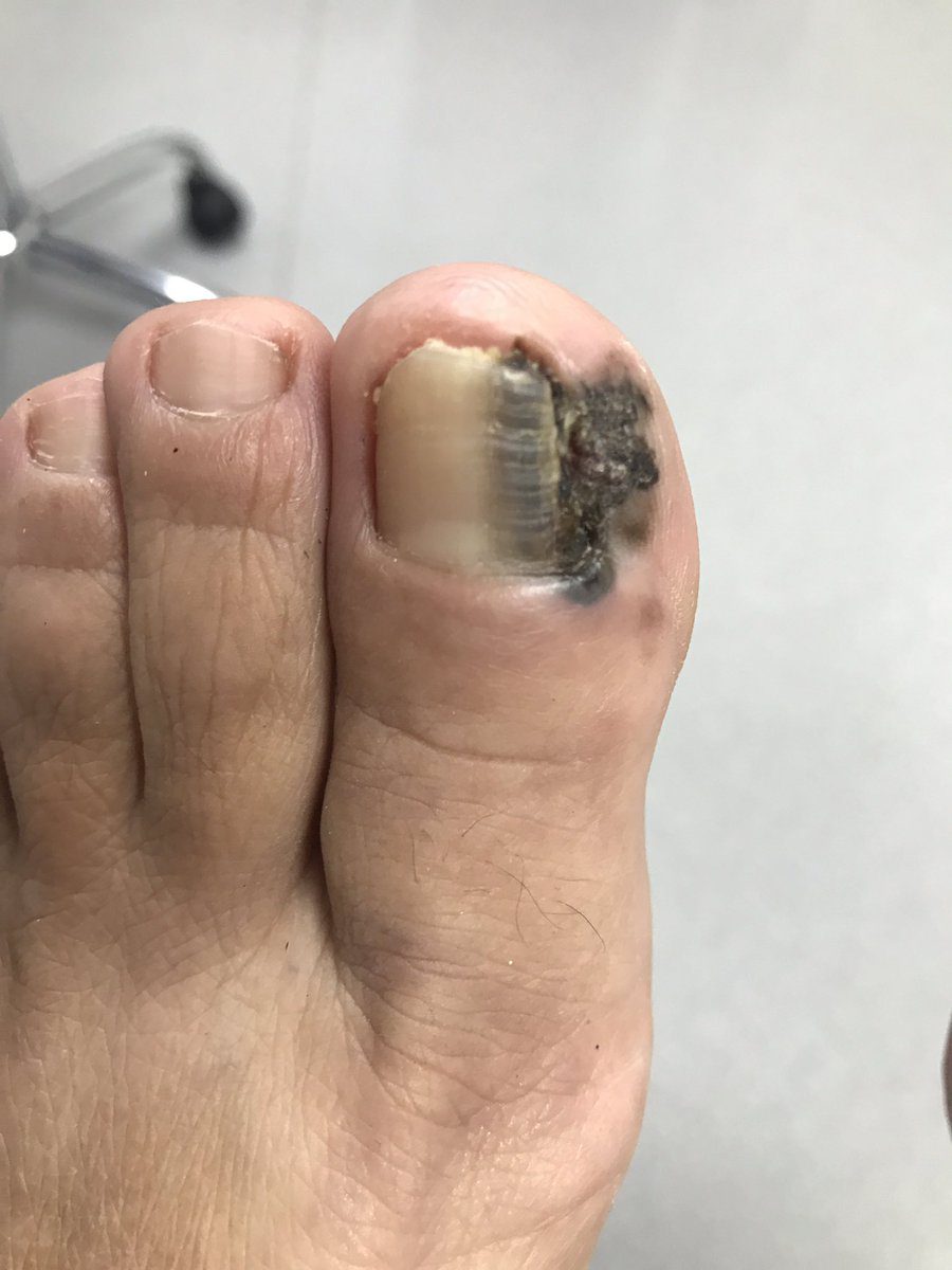 Difference Between Toenail Hematoma and Melanoma | Difference Between