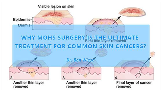 Mohs Surgery: The Ultimate Treatment for Common Skin Cancers post thumbnail