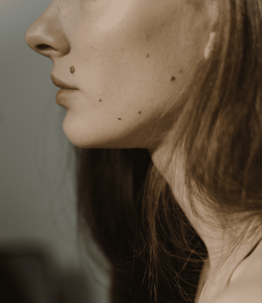 Side profile of a brunette woman's face with several moles on her cheek, relating to monitoring your moles to assess your risk of skin cancer.