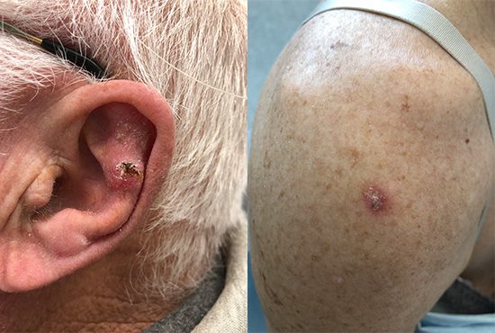 Side by side photos showing cases of squamous cell carcinoma — the first on a man's ear, and the second on a shoulder.