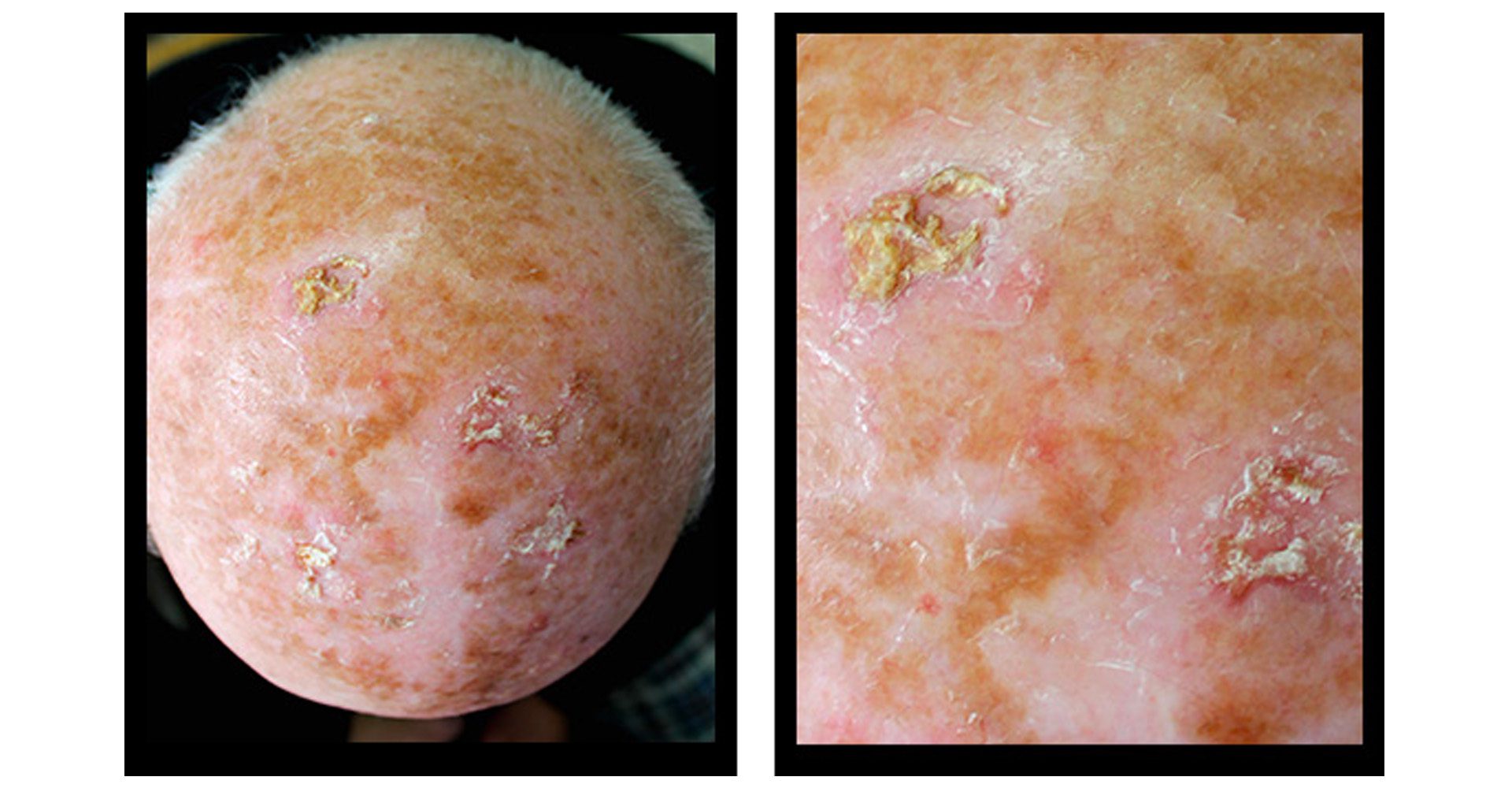 pre cancer skin spots
