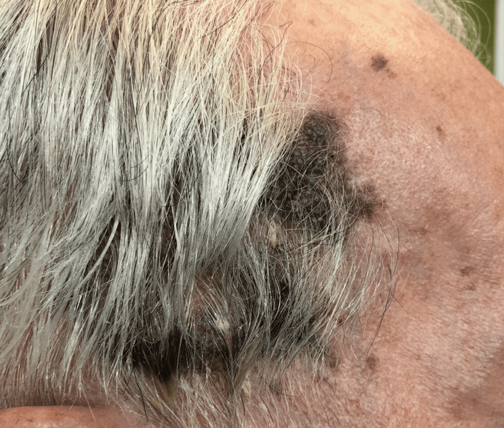 seborrheic keratosis scalp